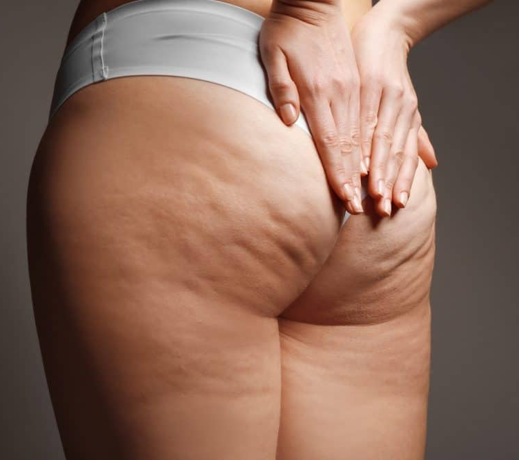 tratamiento anticelulitis